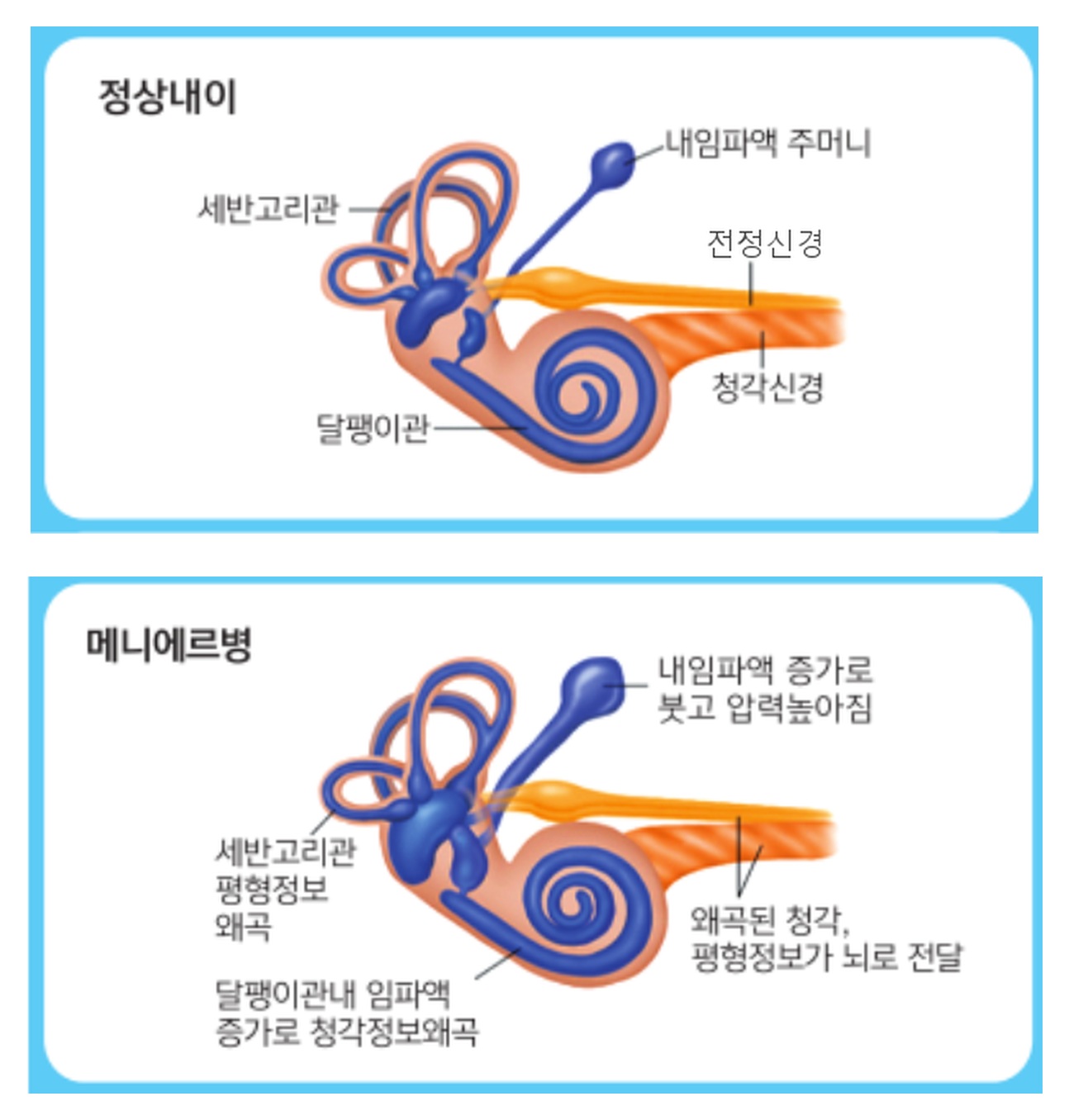 위는 정상 내이, 아래는 내림프액이 늘어 관이 붓고 압력이 높아진 내림프수종 상태